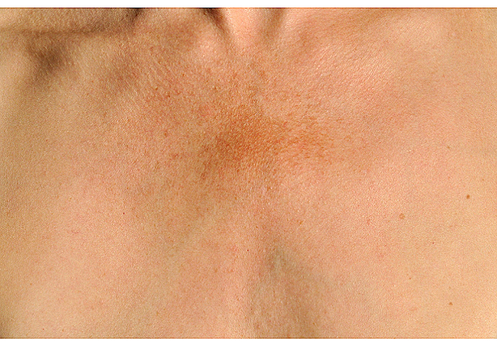 Google Debuts an Artificial Intelligence App For Diagnosing Skin Disorders